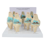 Kit De Joelho: Modelo De Anatomia De Osteoartrite Com Chave