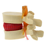 Modelo Anatomico Disco Lombar Coluna Vertebral Humana Hernia